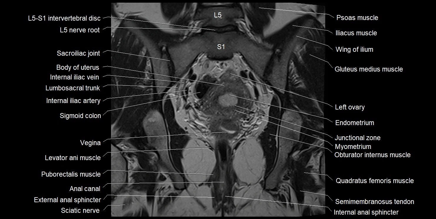 female pelvis coronal cross sectional anatomy image 22.webp